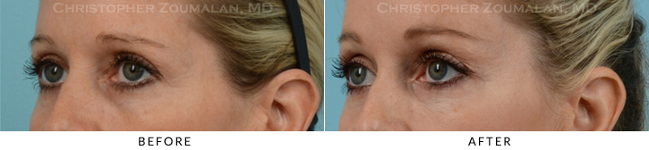 Endoscopic Brow Lift Before & After Photo - Patient Seeing Side - Patient 23C