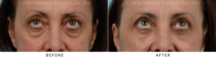 Endoscopic Brow Lift Before & After Photo - Patient Seeing Up - Patient 24A