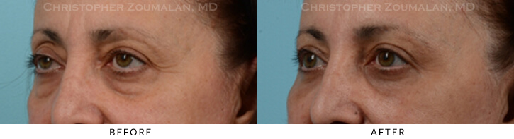 Endoscopic Brow Lift Before & After Photo - Patient Seeing Side - Patient 24B