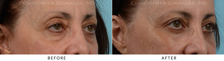 Endoscopic Brow Lift Before & After Photo - Patient Seeing Side - Patient 24C