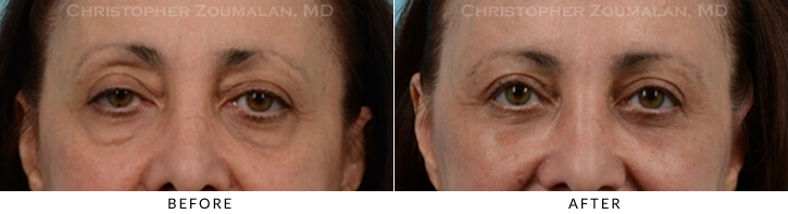 Endoscopic Brow Lift Before & After Photo - Patient Seeing Straight - Patient 24D