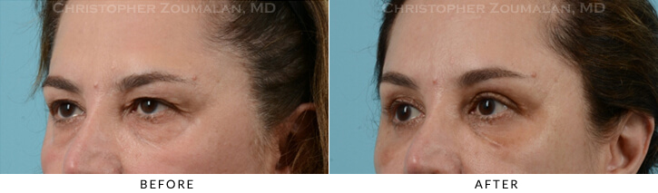 Endoscopic Brow Lift Before & After Photo - Patient Seeing Side - Patient 25A