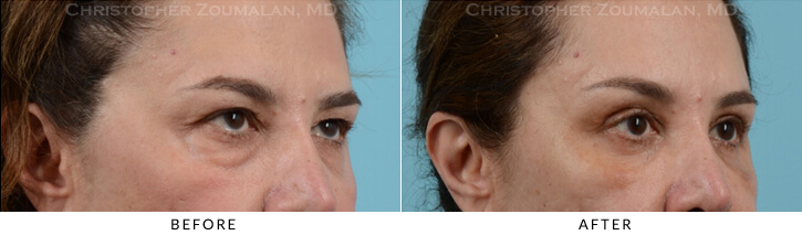 Endoscopic Brow Lift Before & After Photo - Patient Seeing Side - Patient 25B