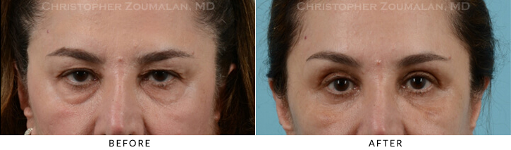 Endoscopic Brow Lift Before & After Photo - Patient Seeing Straight - Patient 25C