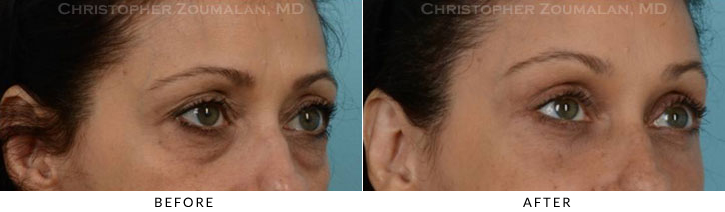 Endoscopic Brow Lift Before & After Photo - Patient Seeing Side - Patient 26A