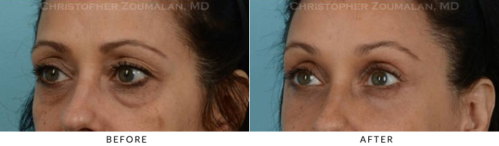 Endoscopic Brow Lift Before & After Photo - Patient Seeing Side - Patient 26B