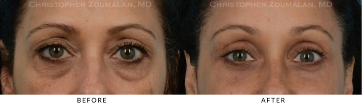 Endoscopic Brow Lift Before & After Photo - Patient Seeing Straight - Patient 26C