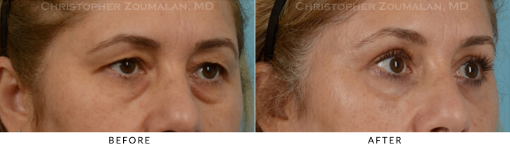Endoscopic Brow Lift Before & After Photo - Patient Seeing Side - Patient 27A
