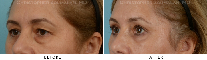 Endoscopic Brow Lift Before & After Photo - Patient Seeing Side - Patient 27B