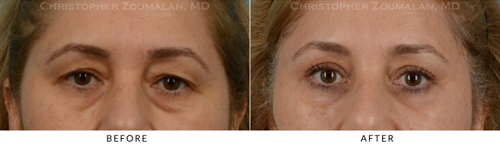 Endoscopic Brow Lift Before & After Photo - Patient Seeing Straight - Patient 27C