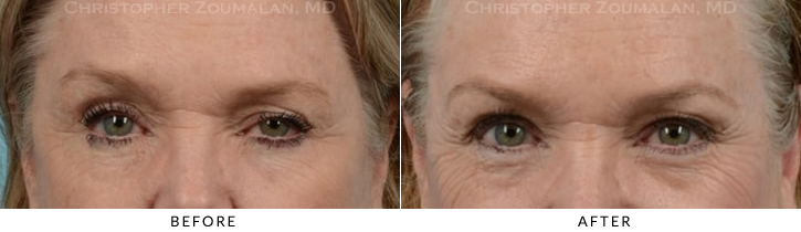 Endoscopic Brow Lift Before & After Photo -  - Patient 28