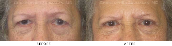 Endoscopic Brow Lift Before & After Photo -  - Patient 29