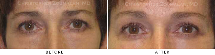Endoscopic Brow Lift Before & After Photo - Patient Seeing Straight - Patient 30A