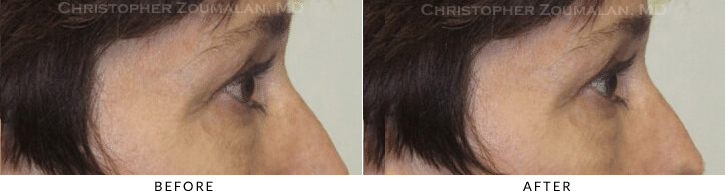 Endoscopic Brow Lift Before & After Photo - Patient Seeing Side - Patient 30B