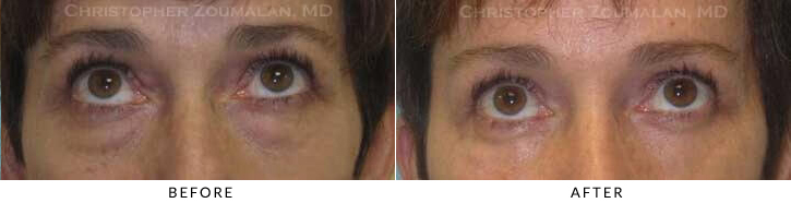 Endoscopic Brow Lift Before & After Photo - Patient Seeing Up - Patient 30C