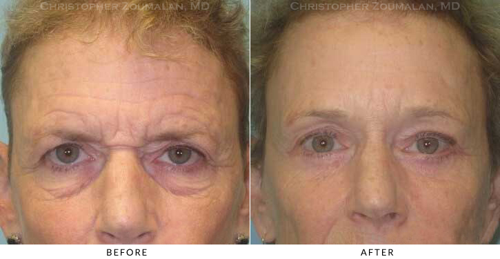 Endoscopic Brow Lift Before & After Photo -  - Patient 31