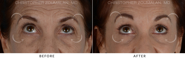 Endoscopic Brow Lift Before & After Photo - Patient Seeing Up - Patient 4B