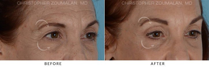 Endoscopic Brow Lift Before & After Photo - Patient Seeing Side - Patient 4C