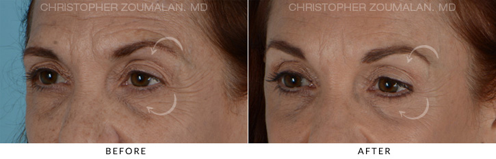 Endoscopic Brow Lift Before & After Photo - Patient Seeing Side - Patient 4D