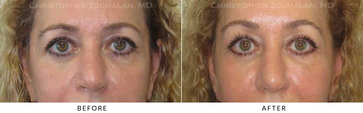 Endoscopic Brow Lift Before & After Photo -  - Patient 32