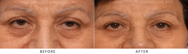 Endoscopic Brow Lift Before & After Photo -  - Patient 33