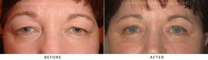 Endoscopic Brow Lift Before & After Photo -  - Patient 35