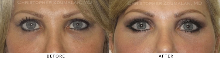 Endoscopic Brow Lift Before & After Photo -  - Patient 36