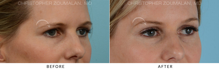 Endoscopic Brow Lift Before & After Photo - Patient Seeing Side - Patient 5A