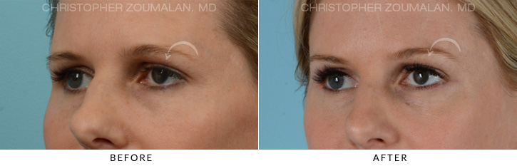 Endoscopic Brow Lift Before & After Photo - Patient Seeing Side - Patient 5B