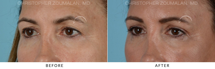 Endoscopic Brow Lift Before & After Photo - Patient Seeing Side - Patient 7B