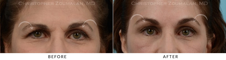 Endoscopic Brow Lift Before & After Photo -  - Patient 8