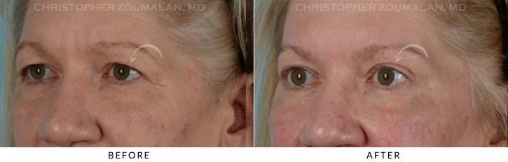 Endoscopic Brow Lift Before & After Photo - Patient Seeing Side - Patient 9B