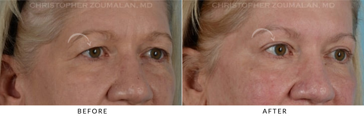 Endoscopic Brow Lift Before & After Photo - Patient Seeing Side - Patient 9C