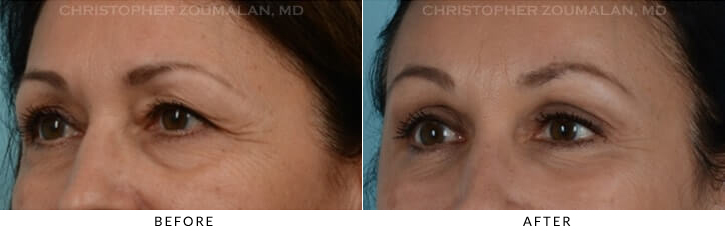 Endoscopic Brow Lift Before & After Photo - Patient Seeing Side - Patient 10A