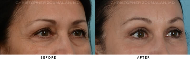 Endoscopic Brow Lift Before & After Photo - Patient Seeing Side - Patient 10B