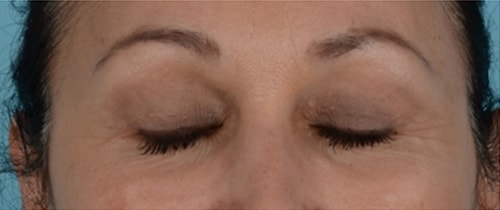 Endoscopic Brow Lift Before & After Photo - Patient with Eyes Closed - Patient 10C