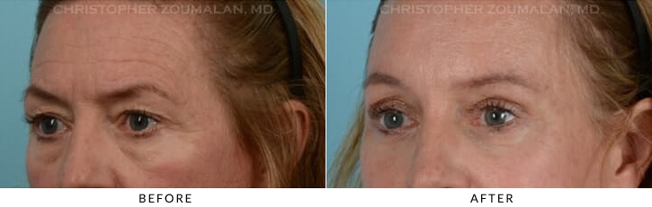 Endoscopic Brow Lift Before & After Photo - Patient Seeing Side - Patient 11A