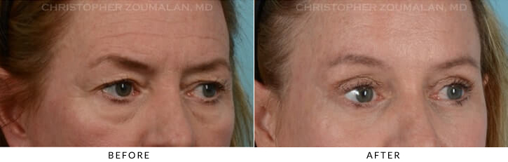Endoscopic Brow Lift Before & After Photo - Patient Seeing Side - Patient 11B