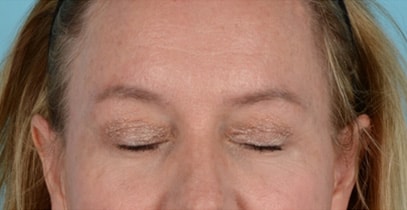 Endoscopic Brow Lift Before & After Photo - Patient with Eyes Closed - Patient 11C
