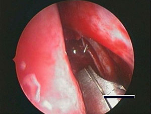 Endoscopic DCR intraoperative view image