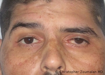 Left sided facial nerve palsy, Note the inability to raise the left brow, He also has a red and painful left eye due to his inability to close his eyelids - male patient before and after picture