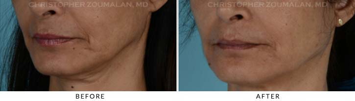 Fillers for Facial Rejuvenation Before & After Photo - Patient Seeing Side - Patient 1A
