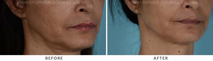 Fillers for Facial Rejuvenation Before & After Photo - Patient Seeing Side - Patient 1B