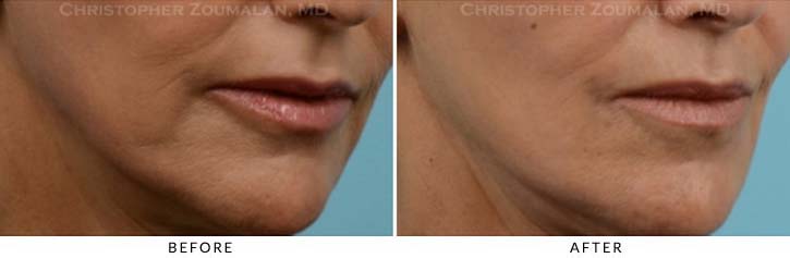 Fillers for Facial Rejuvenation Before & After Photo - Patient Seeing Side - Patient 2