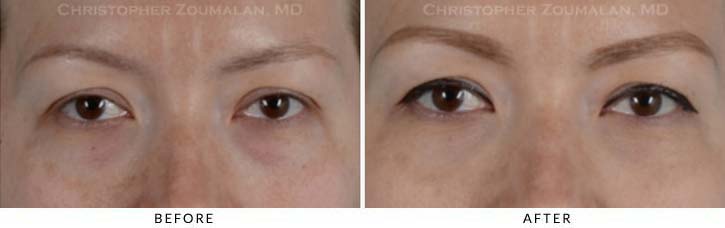 Fillers to treat lower eyelid hollowing Before & After Photo - Patient Seeing Straight - Patient 9A