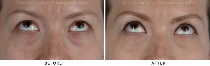 Fillers to treat lower eyelid hollowing Before & After Photo - Patient Seeing Up - Patient 9B