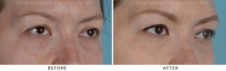 Fillers to treat lower eyelid hollowing Before & After Photo - Patient Seeing Side - Patient 9C