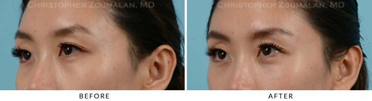 Fillers to treat lower eyelid hollowing Before & After Photo - Patient Seeing Side - Patient 11B