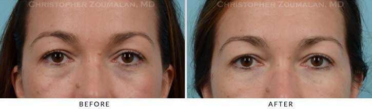 Fillers to treat lower eyelid hollowing Before & After Photo - Patient Seeing Straight - Patient 12