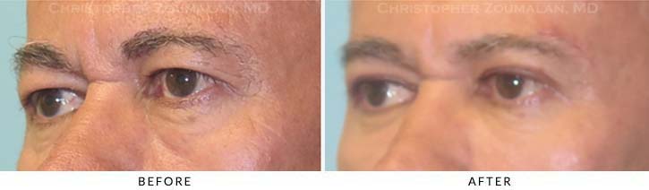 Fillers to treat lower eyelid hollowing Before & After Photo - Patient Seeing Side - Patient 13